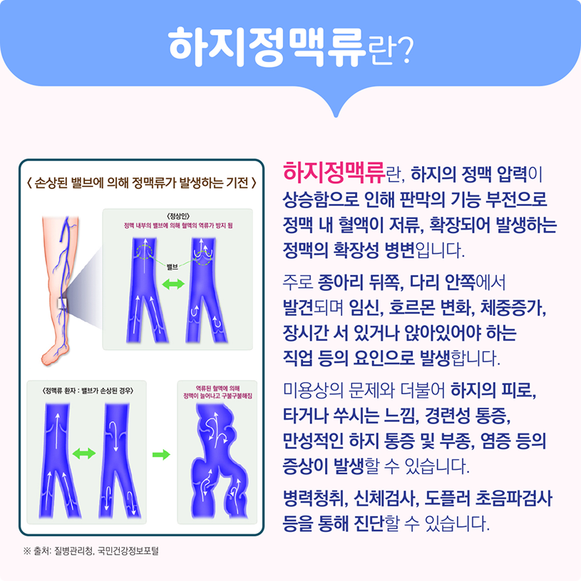 하지정맥류란? 상세내용 하단참조