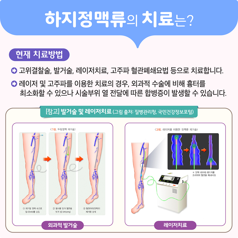 하지정맥류의 치료는? 상세내용 하단참조