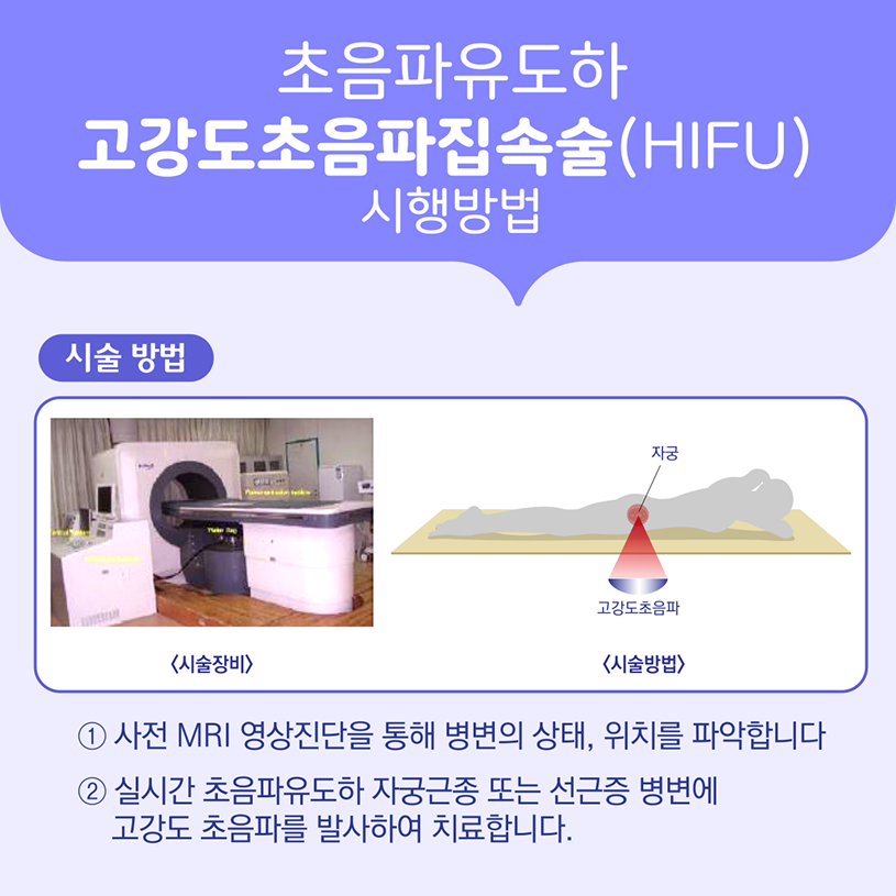초음파유도하 고강도초음파집속술(HIFU) 시행방법/시술방법/1.사전 MRI 영상진단을 통해 병변의 상태, 위치를 파악합니다.2.실시간 초음파유도하 자궁근종 또는 선근증 병변에 고강도 초음파를 발사하여 치료합니다.