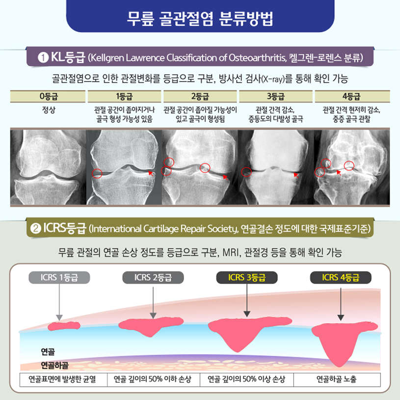 무릎 골관절염 분류방법 상세내용 하단참조