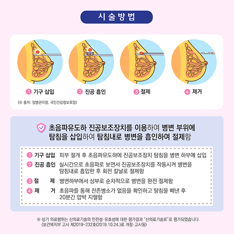 시술방법 상세내용 하단참조