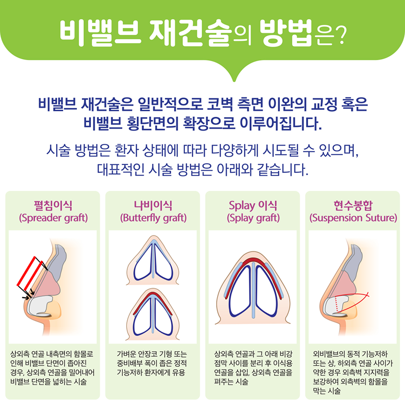 비밸브 재건술의 방법은? 상세내용 하단참조